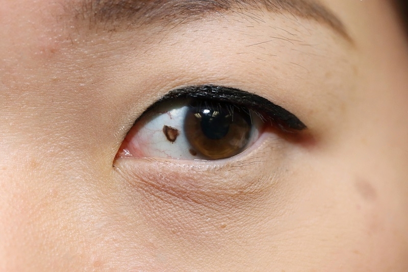 Featured image for an article about Spiritual Meanings of Mole on the Eye